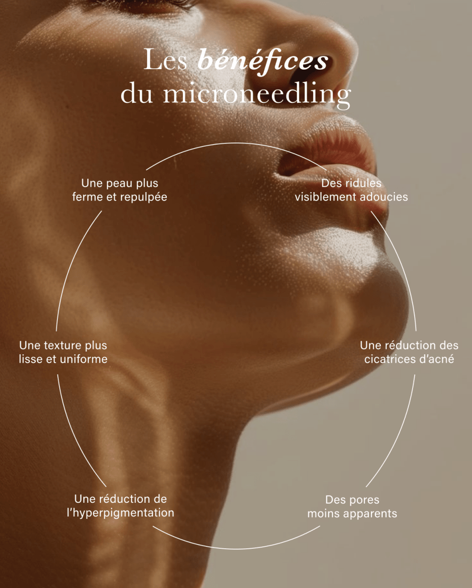 Microneedling Treatment - Beauties Lab - Beauties Lab frimage