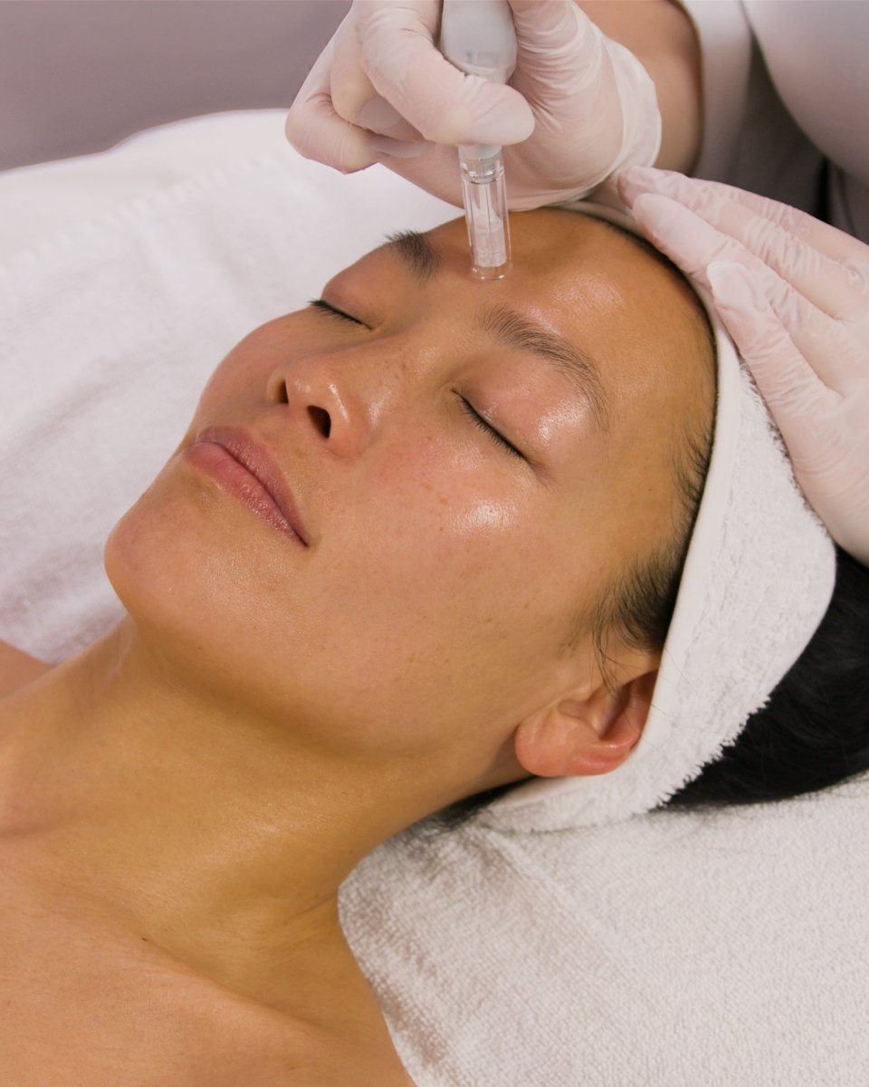 Microneedling Treatment - Beauties Lab - Beauties Lab